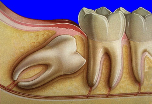 Răng khôn làm lệch mặt - Phương pháp điều trị từ nha khoa 1