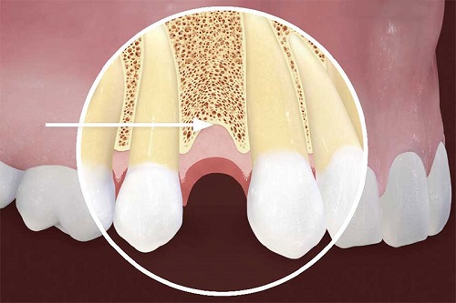 Mất răng lâu năm có trồng được không? Tìm hiểu cách phục hình 2