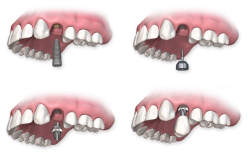 Trồng răng có chân răng khắc phục như thế nào? 2