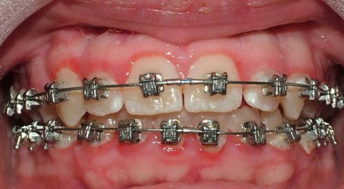 Niềng răng bị viêm lợi - Nguyên nhân do đâu? 1