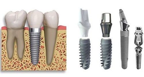 Kinh nghiệm làm răng implant bổ ích cho bạn 3