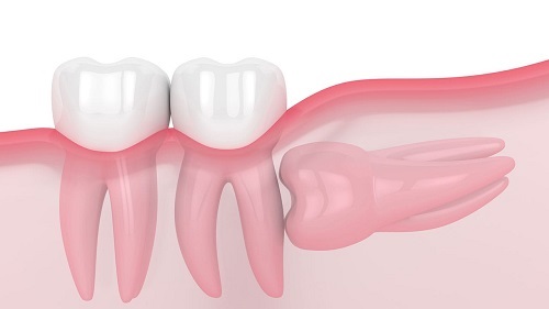 Răng khôn dị dạng - Cách khắc phục hiệu quả an toàn 1