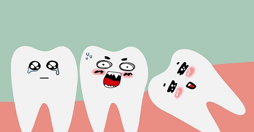 Răng khôn hàm trên bị sâu - Đâu là giải pháp khắc phục 2