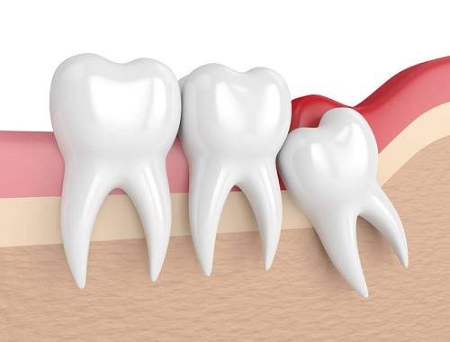 Đau răng khôn dẫn đến đau tai phải làm sao? 1